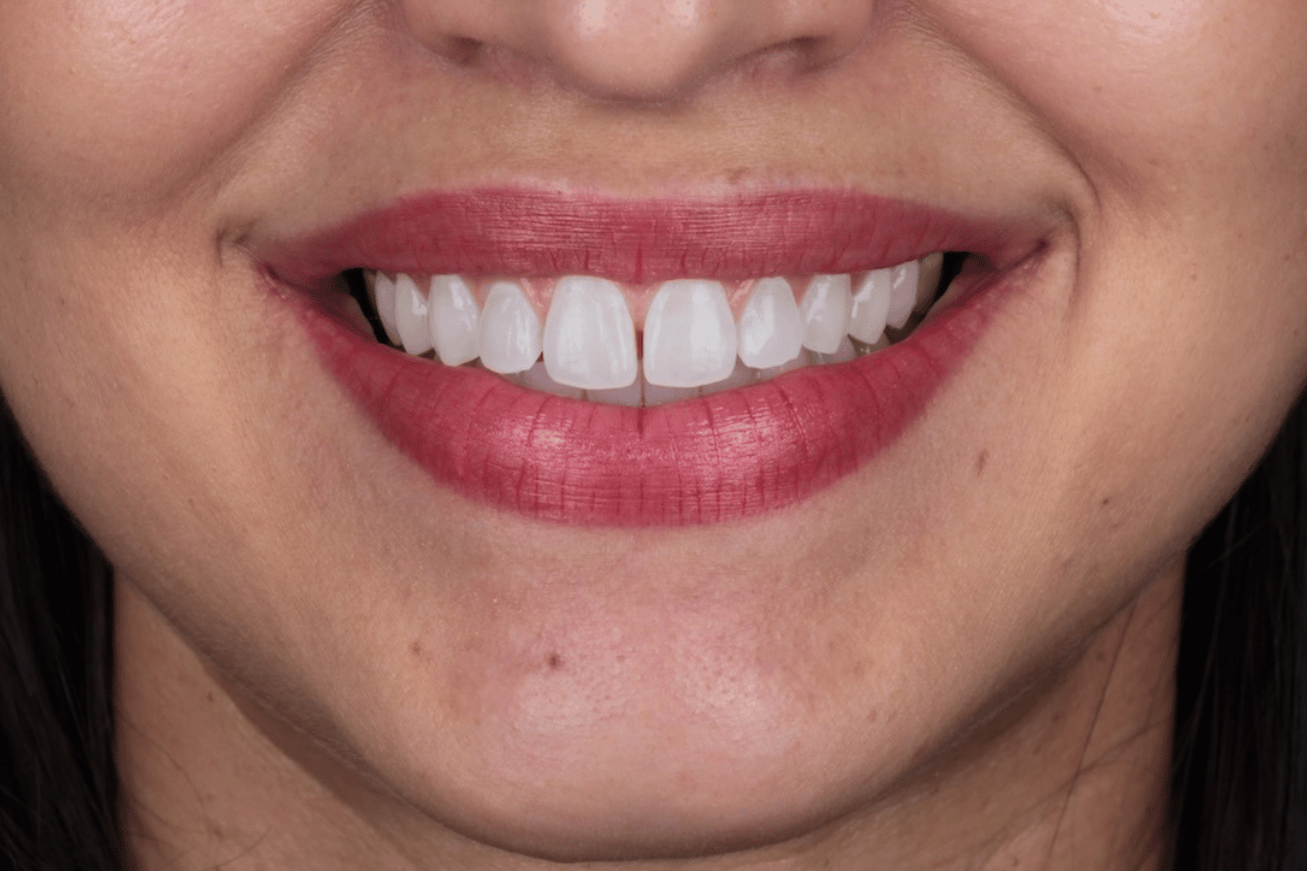 Antes da restauração estética anterior